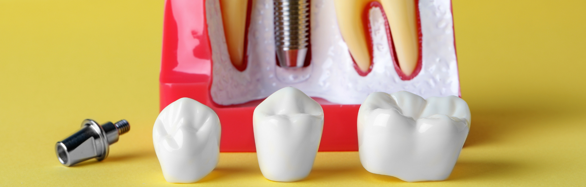 In-Depth Guide to Types of Dental Crowns
